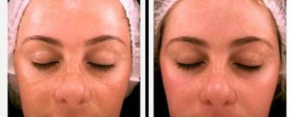 Before and after results for melasma and dark spots following PDT skin treatment