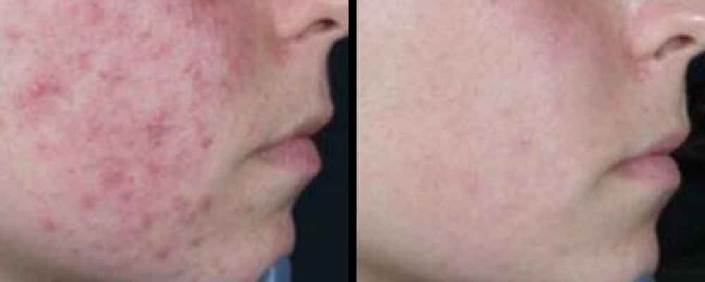 Before and after results for acne and blemish-prone skin following PDT treatment
