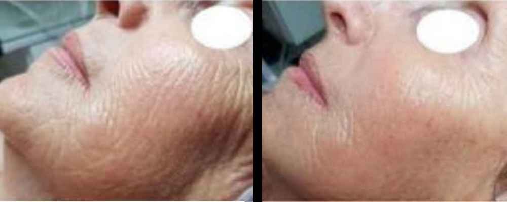 Before and after results for fine lines and wrinkles following PDT skin treatment